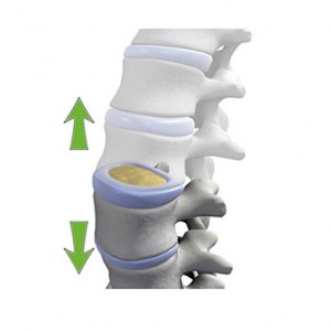 Vertèbre décompressée