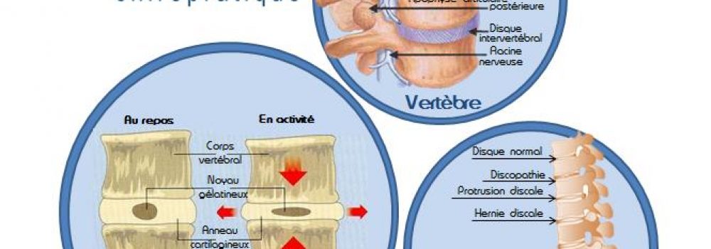 Qu’est-ce qu’une hernie discale ?